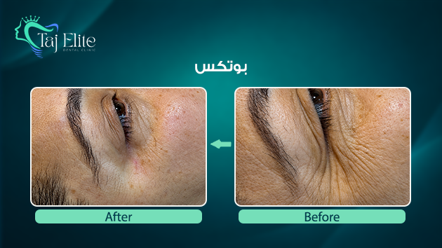 before-^-after20